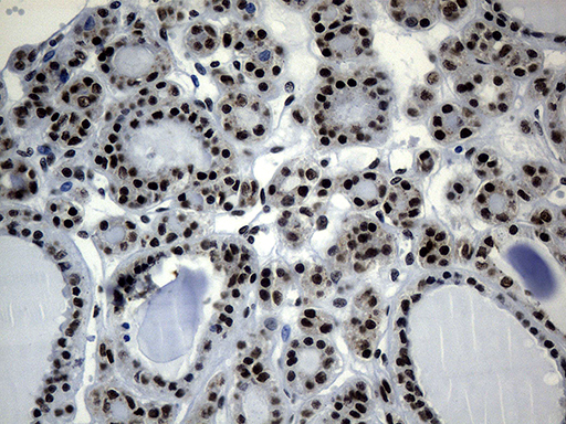 POLR2A / RNA polymerase II Antibody - Immunohistochemical staining of paraffin-embedded Carcinoma of Human thyroid tissue using anti-POLR2A mouse monoclonal antibody. (Heat-induced epitope retrieval by 1mM EDTA in 10mM Tris buffer. (pH8.5) at 120°C for 3 min. (1:500)