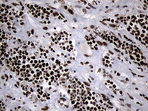 POLR2A / RNA polymerase II Antibody - Immunohistochemical staining of paraffin-embedded Human lymphoma tissue using anti-POLR2A mouse monoclonal antibody. (Heat-induced epitope retrieval by 1mM EDTA in 10mM Tris buffer. (pH8.5) at 120°C for 3 min. (1:500)