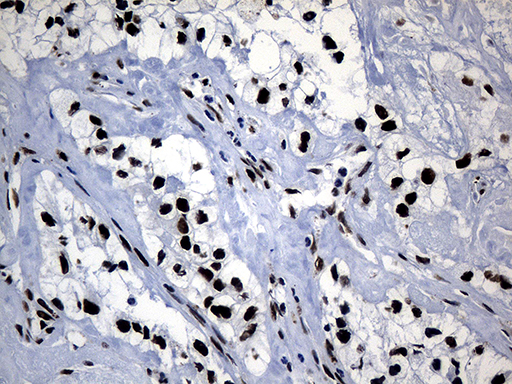 POLR2A / RNA polymerase II Antibody - Immunohistochemical staining of paraffin-embedded Carcinoma of Human kidney tissue using anti-POLR2A mouse monoclonal antibody. (Heat-induced epitope retrieval by 1mM EDTA in 10mM Tris buffer. (pH8.5) at 120°C for 3 min. (1:500)