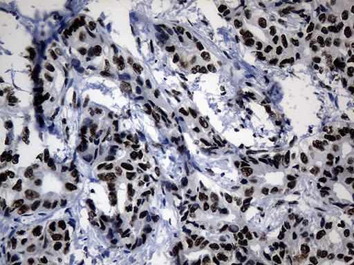 POLR2A / RNA polymerase II Antibody - Immunohistochemical staining of paraffin-embedded Carcinoma of Human liver tissue using anti-POLR2A mouse monoclonal antibody. (Heat-induced epitope retrieval by 1mM EDTA in 10mM Tris buffer. (pH8.5) at 120°C for 3 min. (1:500)