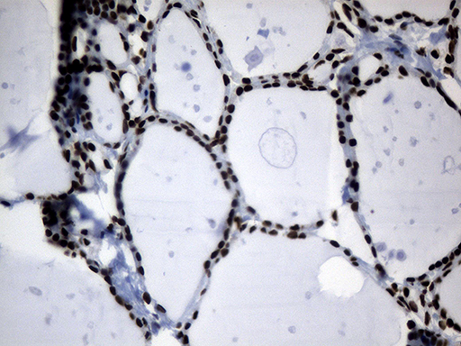 POLR2A / RNA polymerase II Antibody - Immunohistochemical staining of paraffin-embedded Human thyroid tissue within the normal limits using anti-POLR2A mouse monoclonal antibody. (Heat-induced epitope retrieval by 1mM EDTA in 10mM Tris buffer. (pH8.5) at 120°C for 3 min. (1:500)