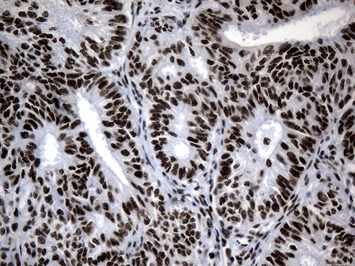 POLR2A / RNA polymerase II Antibody - Immunohistochemical staining of paraffin-embedded Adenocarcinoma of Human endometrium tissue using anti-POLR2A mouse monoclonal antibody. (Heat-induced epitope retrieval by 1mM EDTA in 10mM Tris buffer. (pH8.5) at 120°C for 3 min. (1:500)
