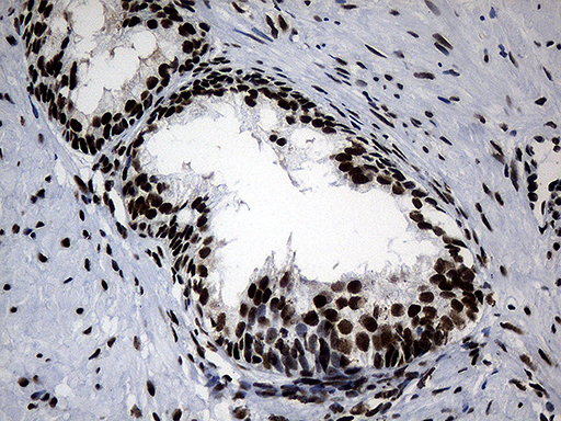 POLR2A / RNA polymerase II Antibody - Immunohistochemical staining of paraffin-embedded Human prostate tissue within the normal limits using anti-POLR2A mouse monoclonal antibody. (Heat-induced epitope retrieval by 1mM EDTA in 10mM Tris buffer. (pH8.5) at 120°C for 3 min. (1:500)
