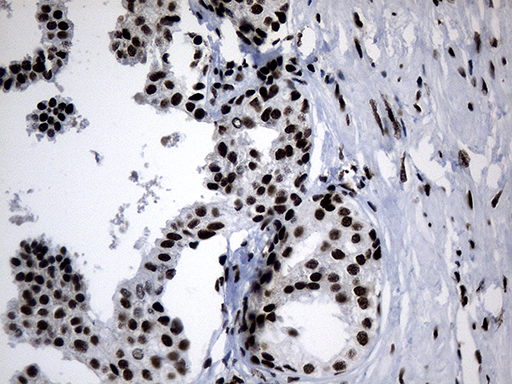 POLR2A / RNA polymerase II Antibody - Immunohistochemical staining of paraffin-embedded Carcinoma of Human prostate tissue using anti-POLR2A mouse monoclonal antibody. (Heat-induced epitope retrieval by 1mM EDTA in 10mM Tris buffer. (pH8.5) at 120°C for 3 min. (1:500)