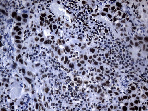 POLR2A / RNA polymerase II Antibody - Immunohistochemical staining of paraffin-embedded Carcinoma of Human bladder tissue using anti-POLR2A mouse monoclonal antibody. (Heat-induced epitope retrieval by 1mM EDTA in 10mM Tris buffer. (pH8.5) at 120°C for 3 min. (1:500)