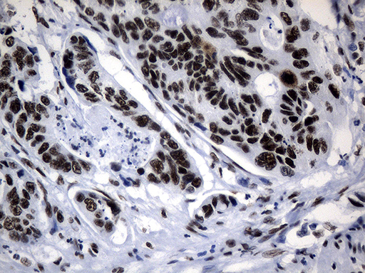 POLR2A / RNA polymerase II Antibody - Immunohistochemical staining of paraffin-embedded Adenocarcinoma of Human colon tissue using anti-POLR2A mouse monoclonal antibody. (Heat-induced epitope retrieval by 1mM EDTA in 10mM Tris buffer. (pH8.5) at 120°C for 3 min. (1:500)