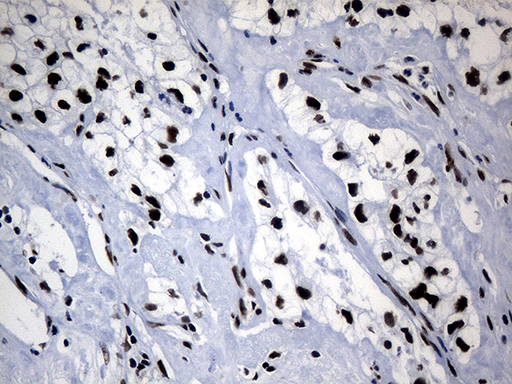 POLR2A / RNA polymerase II Antibody - Immunohistochemical staining of paraffin-embedded Carcinoma of Human kidney tissue using anti-POLR2A mouse monoclonal antibody. (Heat-induced epitope retrieval by 1mM EDTA in 10mM Tris buffer. (pH8.5) at 120°C for 3 min. (1:500)