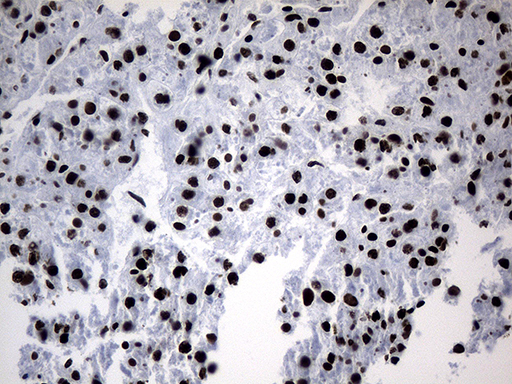 POLR2A / RNA polymerase II Antibody - Immunohistochemical staining of paraffin-embedded Human liver tissue within the normal limits using anti-POLR2A mouse monoclonal antibody. (Heat-induced epitope retrieval by 1mM EDTA in 10mM Tris buffer. (pH8.5) at 120°C for 3 min. (1:500)
