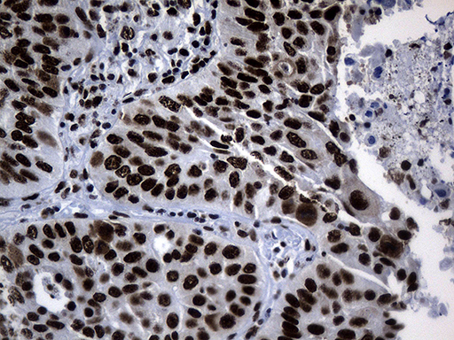 POLR2A / RNA polymerase II Antibody - Immunohistochemical staining of paraffin-embedded Carcinoma of Human lung tissue using anti-POLR2A mouse monoclonal antibody. (Heat-induced epitope retrieval by 1mM EDTA in 10mM Tris buffer. (pH8.5) at 120°C for 3 min. (1:500)