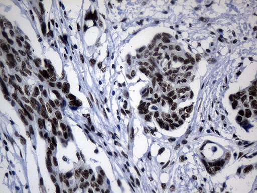 POLR2A / RNA polymerase II Antibody - Immunohistochemical staining of paraffin-embedded Adenocarcinoma of Human ovary tissue using anti-POLR2A mouse monoclonal antibody. (Heat-induced epitope retrieval by 1mM EDTA in 10mM Tris buffer. (pH8.5) at 120°C for 3 min. (1:500)