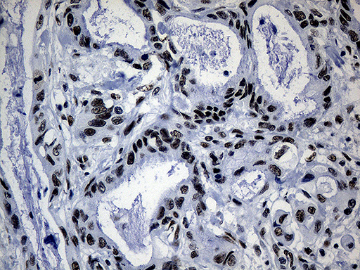 POLR2A / RNA polymerase II Antibody - Immunohistochemical staining of paraffin-embedded Carcinoma of Human pancreas tissue using anti-POLR2A mouse monoclonal antibody. (Heat-induced epitope retrieval by 1mM EDTA in 10mM Tris buffer. (pH8.5) at 120°C for 3 min. (1:500)