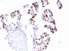 POLR2A / RNA polymerase II Antibody - IHC staining of FFPE human breast carcinoma with POLR2A antibody (clone CTD4H8). HIER: boil tissue sections in pH6, 10mM citrate buffer, for 10-20 min and allow to cool before testing.