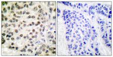 POLR2A / RNA polymerase II Antibody - Peptide - + Immunohistochemical analysis of paraffin-embedded human breast carcinoma tissue using POLR2A (Ab-1619) antibody.