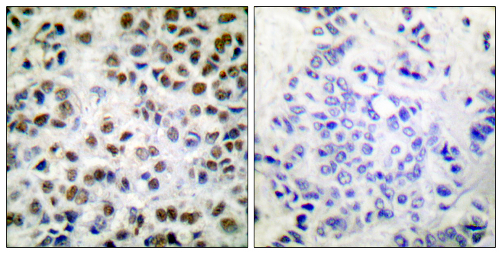 POLR2A / RNA polymerase II Antibody - Immunohistochemistry analysis of paraffin-embedded human breast carcinoma, using POLR2A (Phospho-Ser1619) Antibody. The picture on the right is blocked with the phospho peptide.