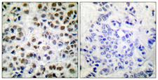 POLR2A / RNA polymerase II Antibody - Immunohistochemistry analysis of paraffin-embedded human breast carcinoma, using POLR2A (Phospho-Ser1619) Antibody. The picture on the right is blocked with the phospho peptide.