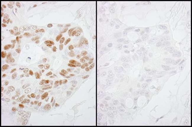 POLR2A / RNA polymerase II Antibody - Detection of Human Phospho-RNA Polymerase II (S2) by Immunohistochemistry. Samples: FFPE serial sections of human ovarian carcinoma. Mock phosphatase treated section (left) or calf intestinal phosphatase-treated section (right) immunostained for Phospho-RNA Polymerase II (S2). Antibody: Affinity purified rabbit anti-Phospho-RNA Polymerase II (S2) used at a dilution of 1:250.