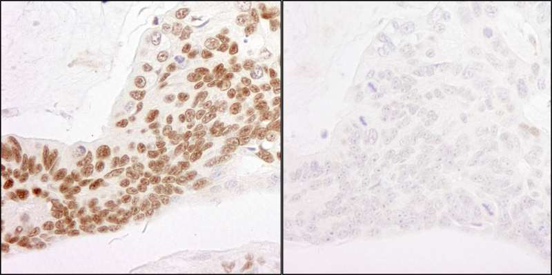 POLR2A / RNA polymerase II Antibody - Detection of Human Phospho-RNA Polymerase II (S2) by Immunohistochemistry. Samples: FFPE serial sections of human ovarian carcinoma. Mock phosphatase treated section (left) and calf intestinal phosphatase-treated section (right). Antibody: Affinity purified rabbit anti-Phospho-RNA Polymerase II (S2) used at a dilution of 1:500 ( 0.4 ug/ml). Detection: DAB.