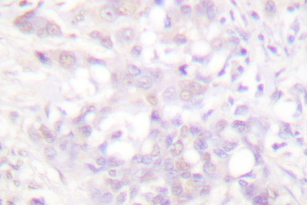 POLR2A / RNA polymerase II Antibody - IHC of POLR2A (P1613) pAb in paraffin-embedded human breast carcinoma tissue.