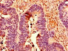 POLR2C Antibody - Immunohistochemistry of paraffin-embedded human ovarian cancer using POLR2C Antibody at dilution of 1:100