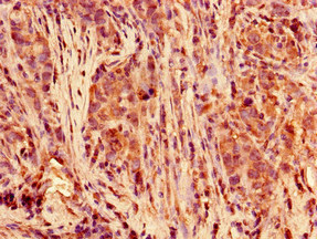 POLR2C Antibody - Immunohistochemistry of paraffin-embedded human pancreatic cancer using POLR2C Antibody at dilution of 1:100