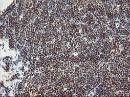POLR2E Antibody - IHC of paraffin-embedded Human lymphoma tissue using anti-POLR2E mouse monoclonal antibody. (Heat-induced epitope retrieval by 10mM citric buffer, pH6.0, 100C for 10min).