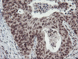 POLR2E Antibody - IHC of paraffin-embedded Carcinoma of Human lung tissue using anti-POLR2E mouse monoclonal antibody. (Heat-induced epitope retrieval by 10mM citric buffer, pH6.0, 100C for 10min).
