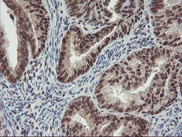 POLR2E Antibody - IHC of paraffin-embedded Adenocarcinoma of Human endometrium tissue using anti-POLR2E mouse monoclonal antibody. (Heat-induced epitope retrieval by 10mM citric buffer, pH6.0, 100C for 10min).