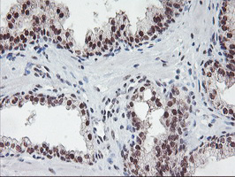 POLR2E Antibody - IHC of paraffin-embedded Carcinoma of Human prostate tissue using anti-POLR2E mouse monoclonal antibody. (Heat-induced epitope retrieval by 10mM citric buffer, pH6.0, 100C for 10min).