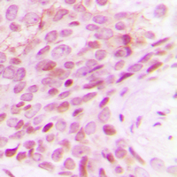 POLR2E Antibody - Immunohistochemical analysis of POLR2E staining in human breast cancer formalin fixed paraffin embedded tissue section. The section was pre-treated using heat mediated antigen retrieval with sodium citrate buffer (pH 6.0). The section was then incubated with the antibody at room temperature and detected using an HRP-conjugated compact polymer system. DAB was used as the chromogen. The section was then counterstained with hematoxylin and mounted with DPX.