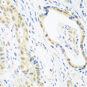POLR2E Antibody - Immunohistochemistry of paraffin-embedded human stomach cancer using POLR2E antibodyat dilution of 1:100 (40x lens).
