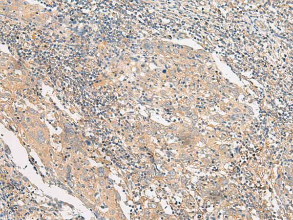 POLR2L Antibody - Immunohistochemistry of paraffin-embedded Human cervical cancer tissue  using POLR2L Polyclonal Antibody at dilution of 1:45(×200)