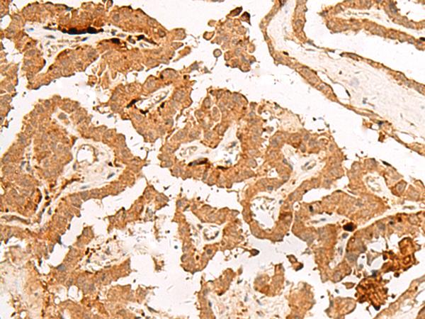 POLR2L Antibody - Immunohistochemistry of paraffin-embedded Human thyroid cancer tissue  using POLR2L Polyclonal Antibody at dilution of 1:45(×200)