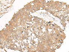 POLR2L Antibody - Immunohistochemistry of paraffin-embedded Human lung cancer tissue  using POLR2L Polyclonal Antibody at dilution of 1:40(×200)