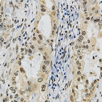 POLR3A Antibody - Immunohistochemical analysis of POLR3A staining in human lung cancer formalin fixed paraffin embedded tissue section. The section was pre-treated using heat mediated antigen retrieval with sodium citrate buffer (pH 6.0). The section was then incubated with the antibody at room temperature and detected with HRP and DAB as chromogen. The section was then counterstained with hematoxylin and mounted with DPX.