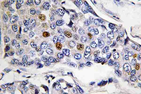 POLR3A Antibody - IHC of POLR3A (P68) pAb in paraffin-embedded human breast carcinoma tissue.