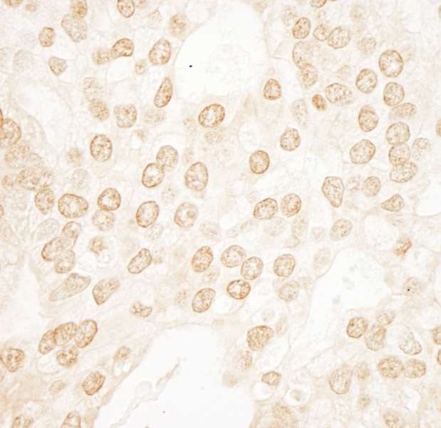 POLR3B Antibody - Detection of Human RPC2 by Immunohistochemistry. Sample: FFPE section of human prostate carcinoma. Antibody: Affinity purified rabbit anti-RPC2 used at a dilution of 1:1000 (0.2 ug/ml). Detection: DAB.