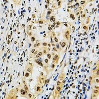 POLR3B Antibody - Immunohistochemical analysis of POLR3B staining in human lung cancer formalin fixed paraffin embedded tissue section. The section was pre-treated using heat mediated antigen retrieval with sodium citrate buffer (pH 6.0). The section was then incubated with the antibody at room temperature and detected with HRP and DAB as chromogen. The section was then counterstained with hematoxylin and mounted with DPX.