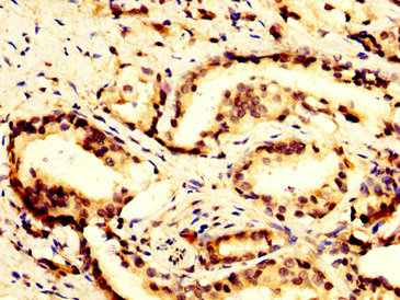 POLR3B Antibody - Immunohistochemistry image at a dilution of 1:300 and staining in paraffin-embedded human prostate cancer performed on a Leica BondTM system. After dewaxing and hydration, antigen retrieval was mediated by high pressure in a citrate buffer (pH 6.0) . Section was blocked with 10% normal goat serum 30min at RT. Then primary antibody (1% BSA) was incubated at 4 °C overnight. The primary is detected by a biotinylated secondary antibody and visualized using an HRP conjugated SP system.