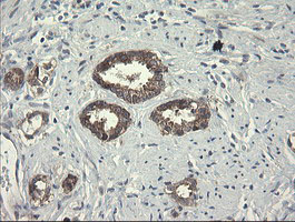 POLR3C Antibody - IHC of paraffin-embedded Carcinoma of Human prostate tissue using anti-POLR3C mouse monoclonal antibody.