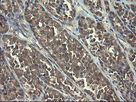 POLR3C Antibody - IHC of paraffin-embedded Carcinoma of Human thyroid tissue using anti-POLR3C mouse monoclonal antibody.
