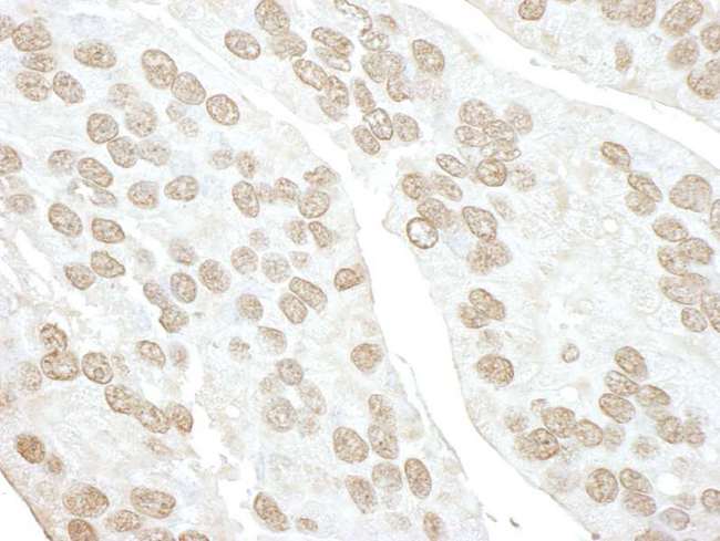 POLR3D Antibody - Detection of Human POLR3D by Immunohistochemistry. Sample: FFPE section of human prostate carcinoma. Antibody: Affinity purified rabbit anti-POLR3D used at a dilution of 1:100.
