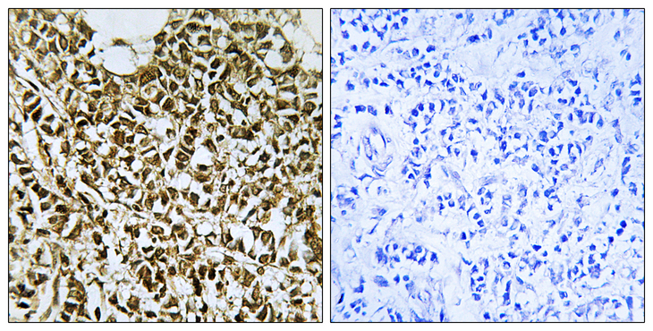 POLR3E / SIN Antibody - Immunohistochemistry analysis of paraffin-embedded human breast carcinoma tissue, using RPC5 Antibody. The picture on the right is blocked with the synthesized peptide.