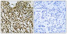 POLR3E / SIN Antibody - Peptide - + Immunohistochemistry analysis of paraffin-embedded human breast carcinoma tissue using RPC5 antibody.