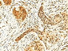 POLR3F Antibody - Immunohistochemistry of paraffin-embedded Human esophagus cancer tissue  using POLR3F Polyclonal Antibody at dilution of 1:50(×200)