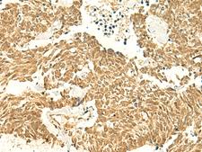 POLR3F Antibody - Immunohistochemistry of paraffin-embedded Human lung cancer tissue  using POLR3F Polyclonal Antibody at dilution of 1:50(×200)