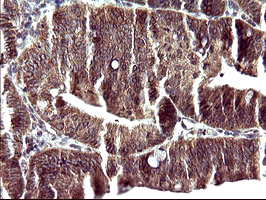 POLR3GL Antibody - IHC of paraffin-embedded Carcinoma of Human pancreas tissue using anti-POLR3GL mouse monoclonal antibody. (Heat-induced epitope retrieval by 10mM citric buffer, pH6.0, 120°C for 3min).
