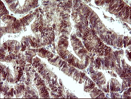 POLR3GL Antibody - IHC of paraffin-embedded Adenocarcinoma of Human endometrium tissue using anti-POLR3GL mouse monoclonal antibody. (Heat-induced epitope retrieval by 10mM citric buffer, pH6.0, 120°C for 3min).