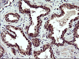 POLR3GL Antibody - IHC of paraffin-embedded Carcinoma of Human prostate tissue using anti-POLR3GL mouse monoclonal antibody. (Heat-induced epitope retrieval by 10mM citric buffer, pH6.0, 120°C for 3min).