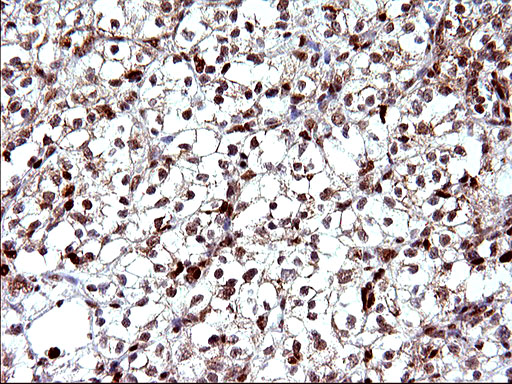 POLR3GL Antibody - IHC of paraffin-embedded Carcinoma of Human kidney tissue using anti-POLR3GL mouse monoclonal antibody. (Heat-induced epitope retrieval by 10mM citric buffer, pH6.0, 120°C for 3min).