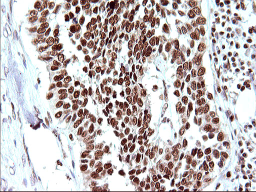 POLR3GL Antibody - IHC of paraffin-embedded Carcinoma of Human bladder tissue using anti-POLR3GL mouse monoclonal antibody. (Heat-induced epitope retrieval by 10mM citric buffer, pH6.0, 120°C for 3min).
